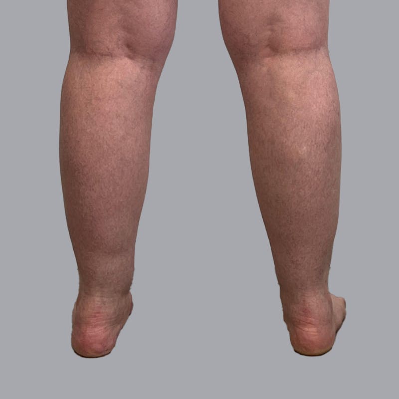 Leg Liposuction Before & After Gallery - Patient 947698 - Image 1