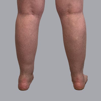 Lipedema Before & After Gallery - Patient 949692 - Image 1