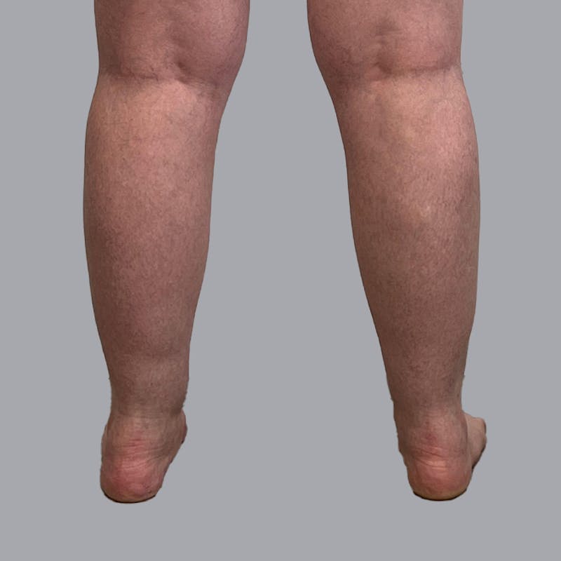 Liposuction Before & After Gallery - Patient 106615587 - Image 1