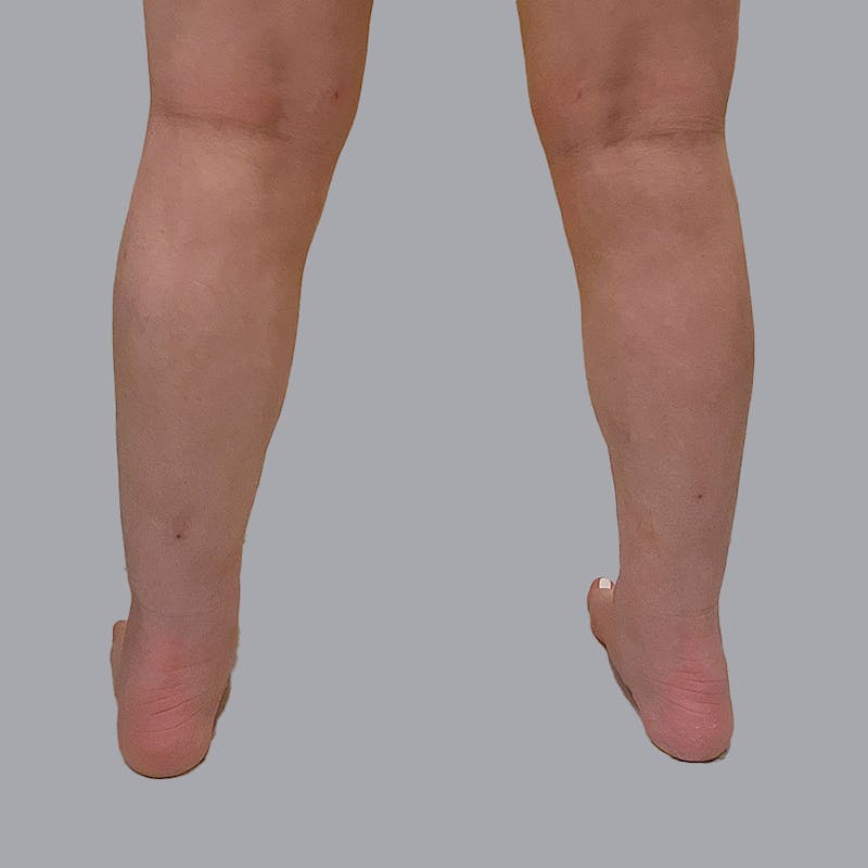 Leg Liposuction Before & After Gallery - Patient 947698 - Image 2