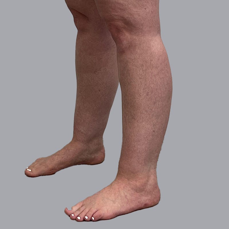 Leg Liposuction Before & After Gallery - Patient 947698 - Image 3