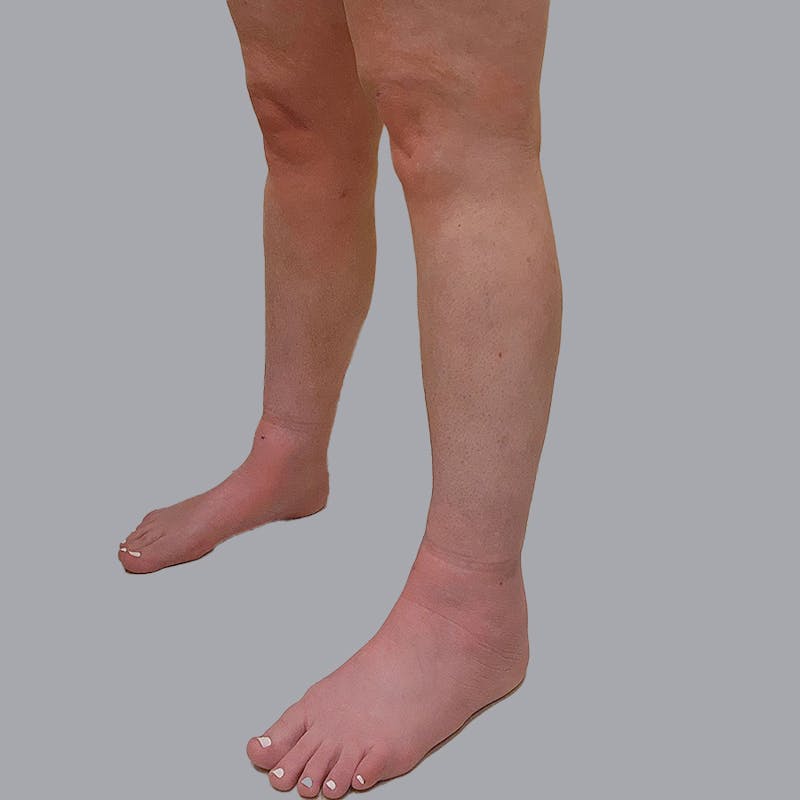 Leg Liposuction Before & After Gallery - Patient 947698 - Image 4
