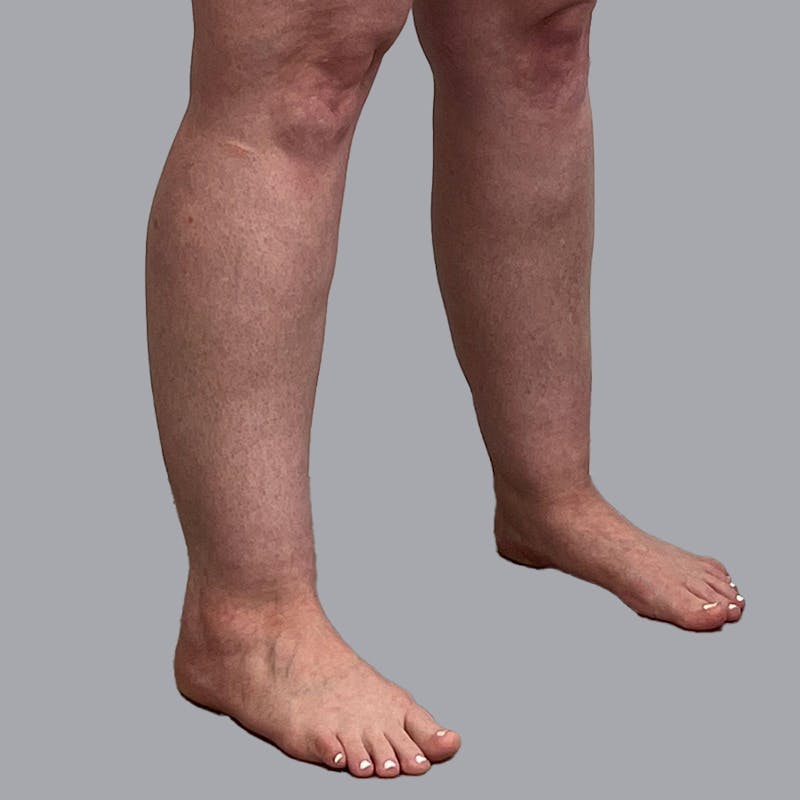 Leg Liposuction Before & After Gallery - Patient 947698 - Image 5