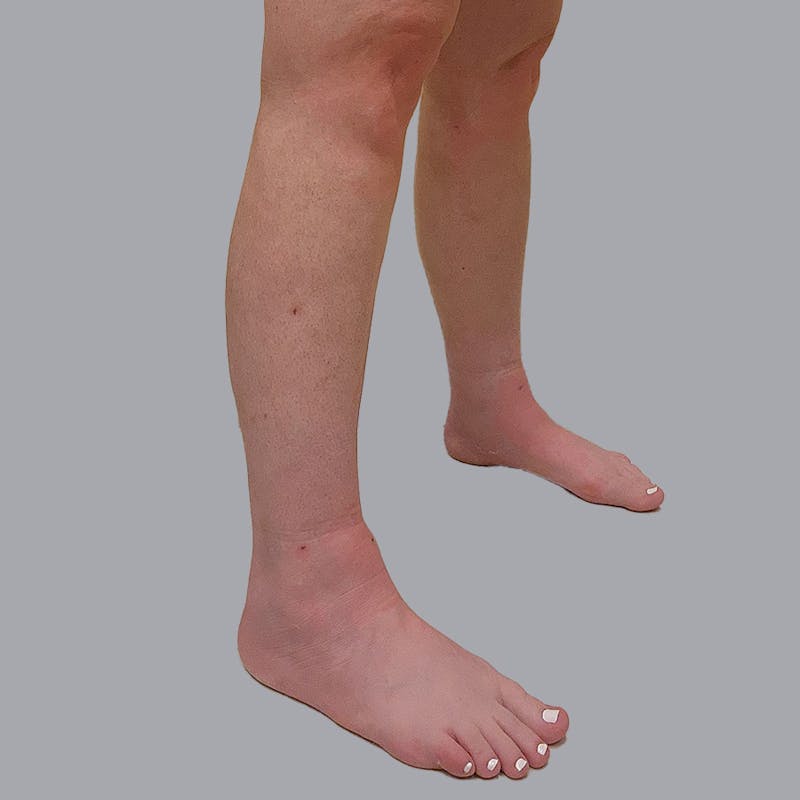 Leg Liposuction Before & After Gallery - Patient 947698 - Image 6