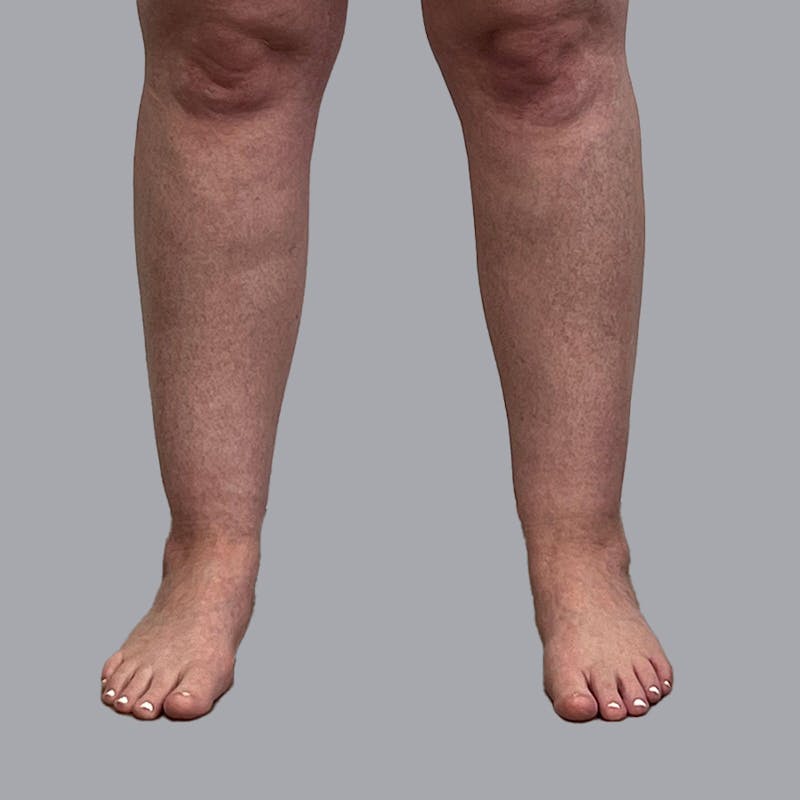 Leg Liposuction Before & After Gallery - Patient 947698 - Image 7
