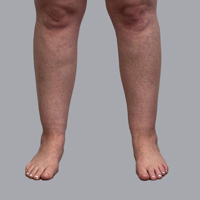 Lipedema Before & After Gallery - Patient 949692 - Image 7