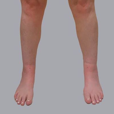 Lipedema Before & After Gallery - Patient 949692 - Image 8