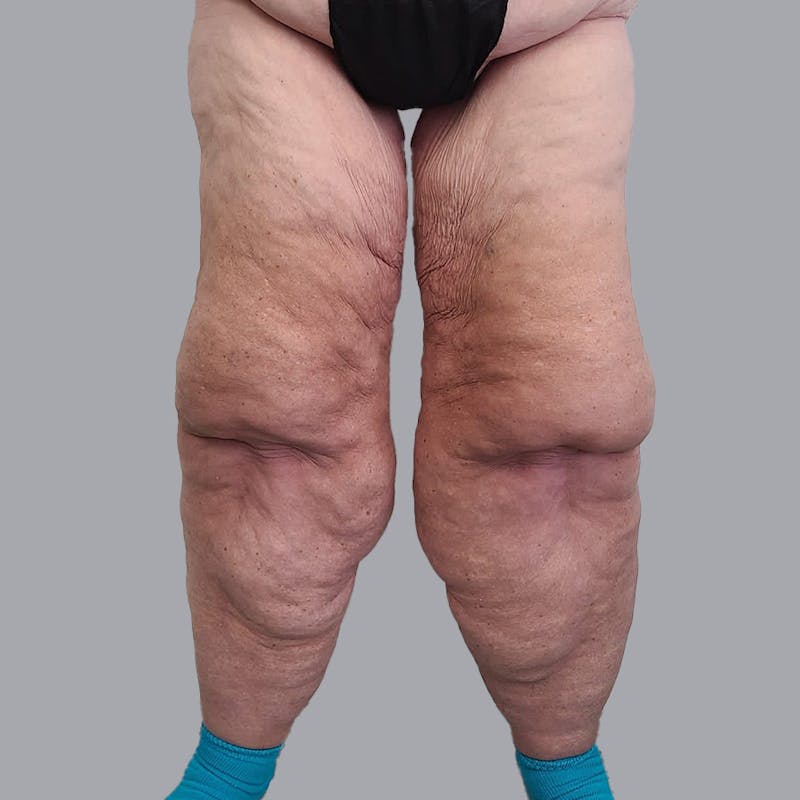 Lipedema Before & After Gallery - Patient 106640107 - Image 1