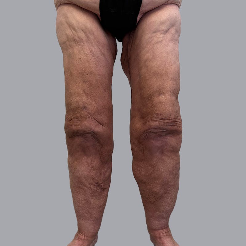 Lipedema Before & After Gallery - Patient 106640107 - Image 2