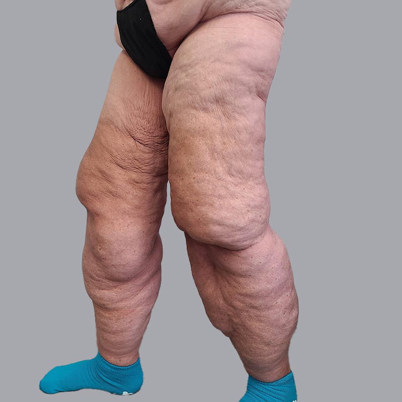 Lipedema Before & After Gallery - Patient 106640107 - Image 3