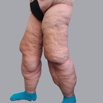Lipedema Before & After Gallery - Patient 106640107 - Image 3