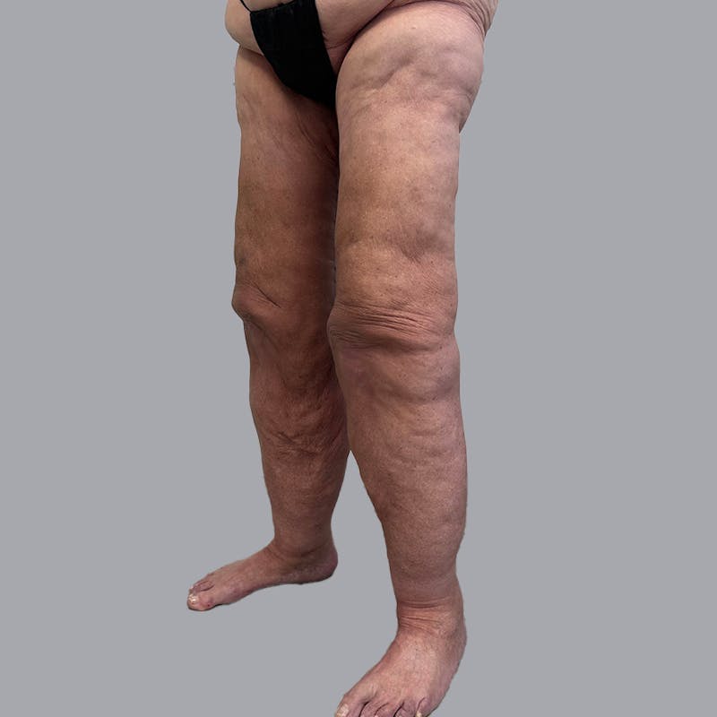Lipedema Before & After Gallery - Patient 106640107 - Image 4