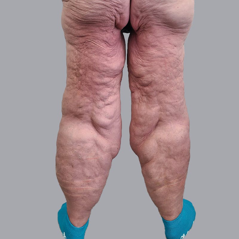 Lipedema Before & After Gallery - Patient 106640107 - Image 5