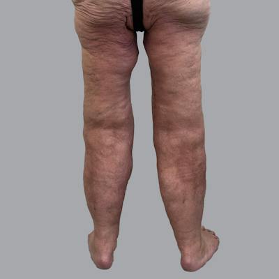 Lipedema Before & After Gallery - Patient 106640107 - Image 6