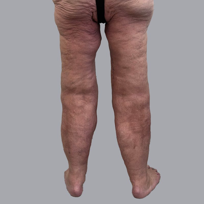 Lipedema Before & After Gallery - Patient 106640107 - Image 6