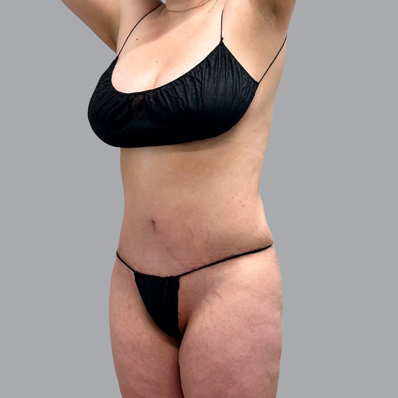 Liposuction Before & After Gallery - Patient 132011508 - Image 4