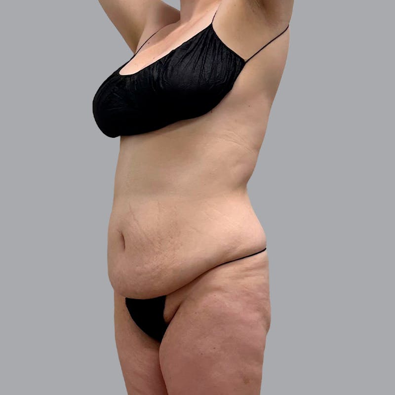 Liposuction Before & After Gallery - Patient 132011508 - Image 3