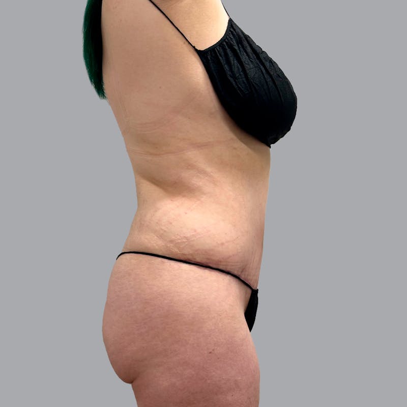 Abdominoplasty Before & After Gallery - Patient 132011507 - Image 6