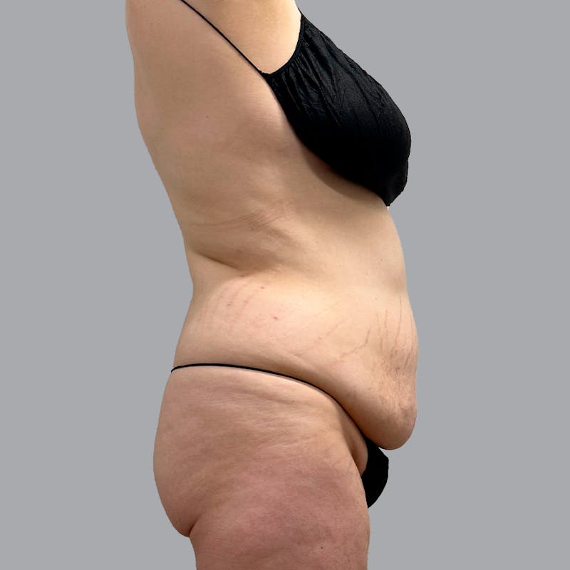 Abdominoplasty Before & After Gallery - Patient 132011507 - Image 5