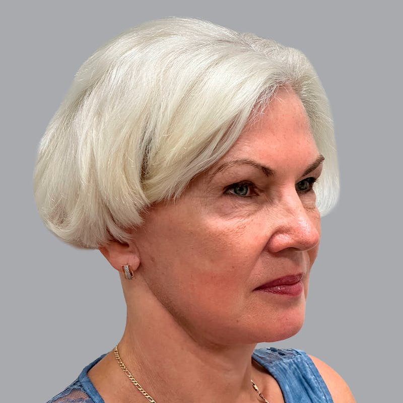 Facelift and Neck Lift Before & After Gallery - Patient 133923227 - Image 4