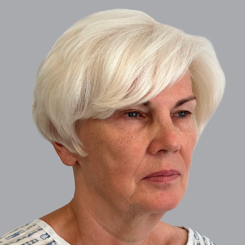 Facelift and Neck Lift Before & After Gallery - Patient 133923227 - Image 3