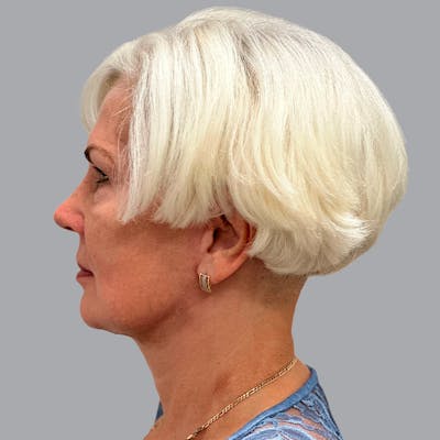 Facelift and Neck Lift Before & After Gallery - Patient 133923227 - Image 6