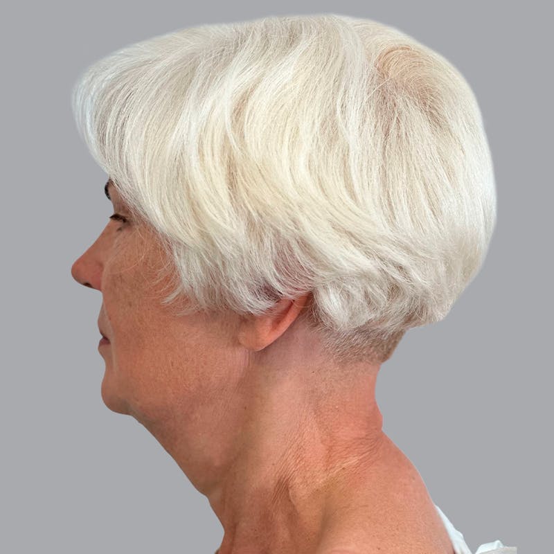 Facelift and Neck Lift Before & After Gallery - Patient 133923227 - Image 3