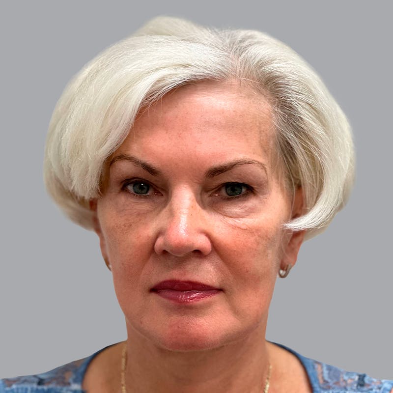 Facelift and Neck Lift Before & After Gallery - Patient 133923227 - Image 6