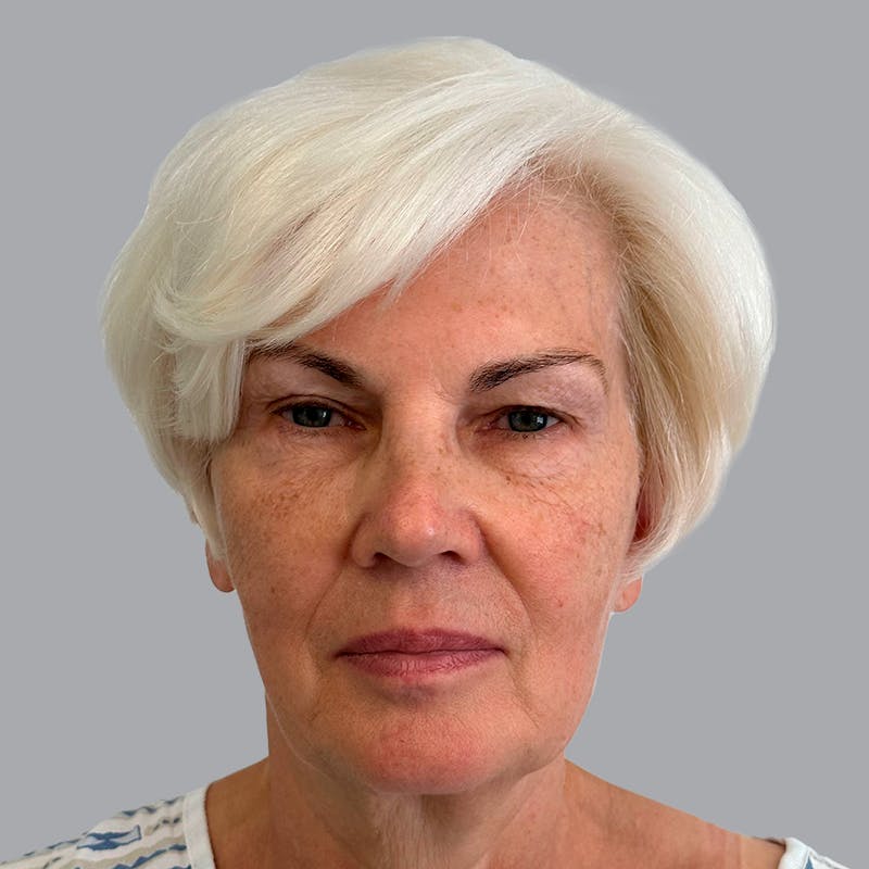 Facelift and Neck Lift Before & After Gallery - Patient 133923227 - Image 5
