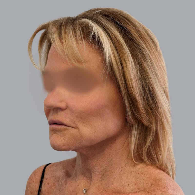 Facelift and Neck Lift Before & After Gallery - Patient 138737829 - Image 4