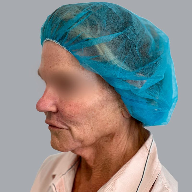 Facelift and Neck Lift Before & After Gallery - Patient 138737829 - Image 3