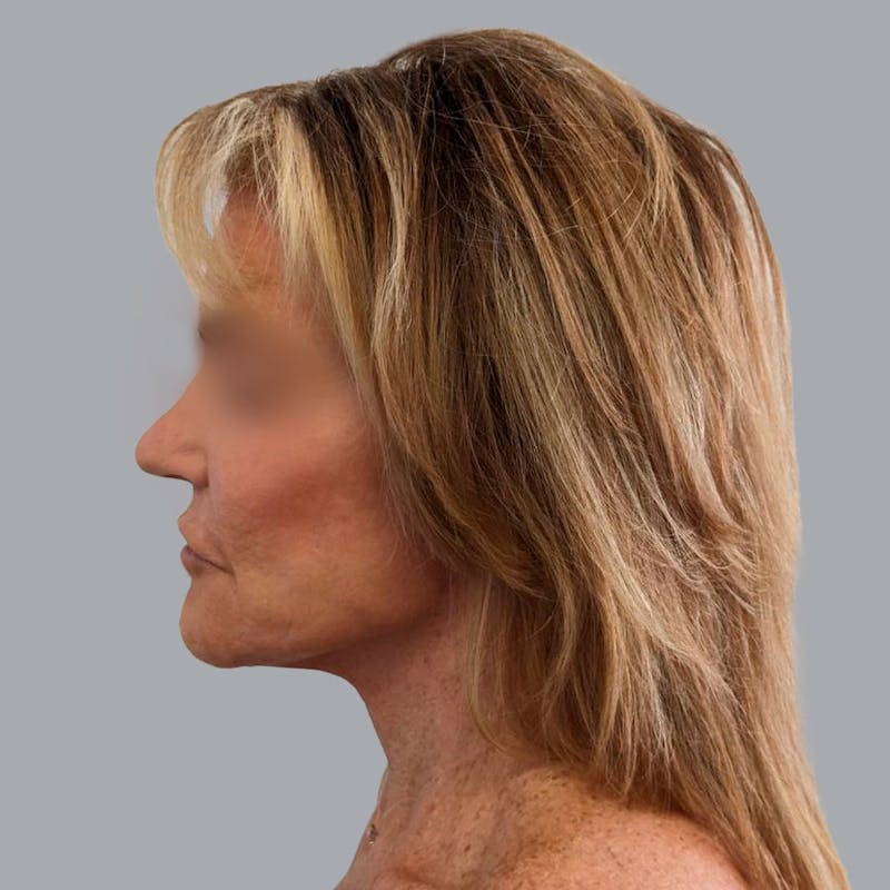 Facelift and Neck Lift Before & After Gallery - Patient 138737829 - Image 6
