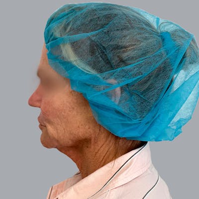 Facelift and Neck Lift Before & After Gallery - Patient 138737829 - Image 5