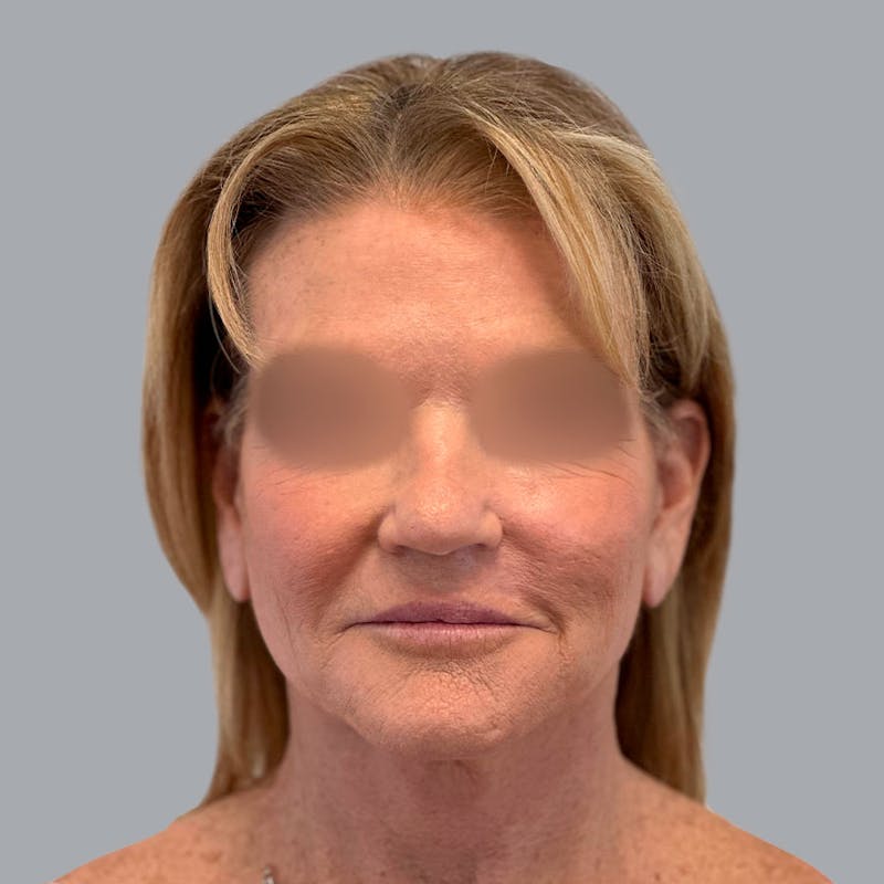 Facelift and Neck Lift Before & After Gallery - Patient 138737829 - Image 2
