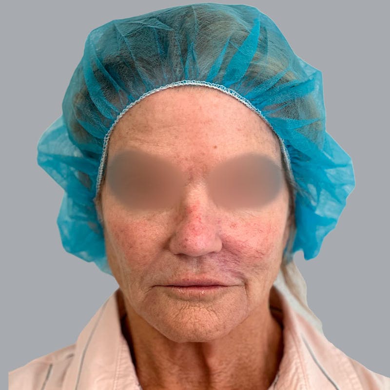 Facelift and Neck Lift Before & After Gallery - Patient 138737829 - Image 1
