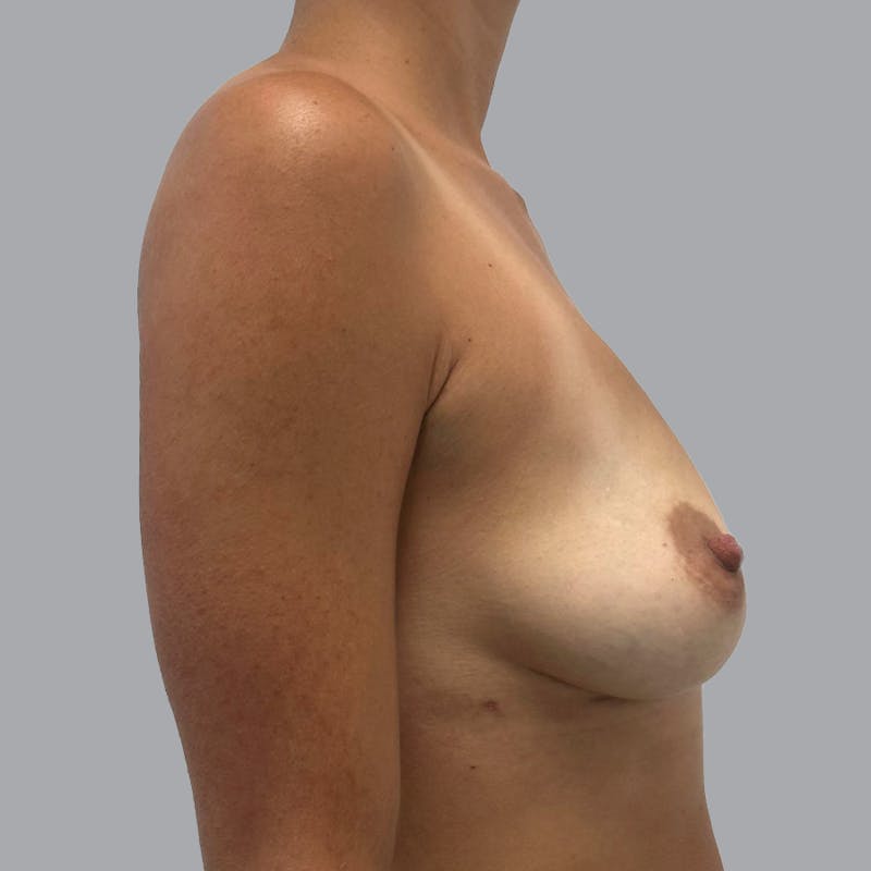 Breast Implant Removal Before & After Gallery - Patient 142570657 - Image 6