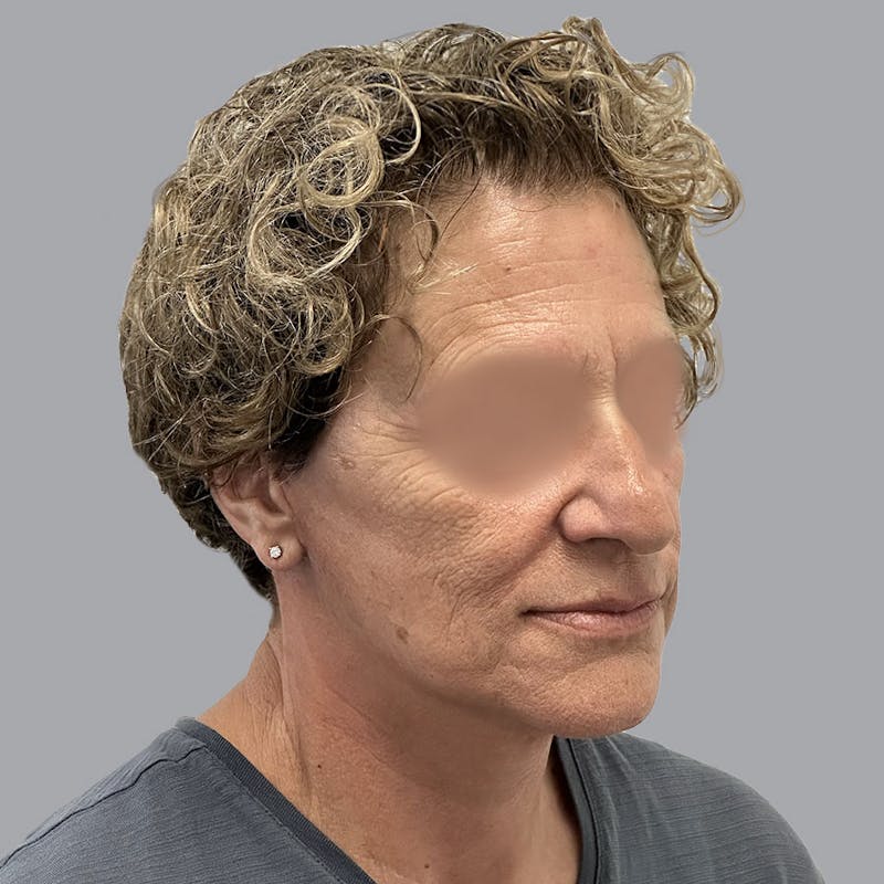 Facelift and Neck Lift Before & After Gallery - Patient 173374025 - Image 2