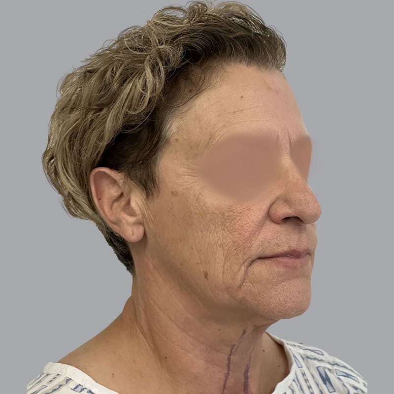 Facelift and Neck Lift Before & After Gallery - Patient 173374025 - Image 1