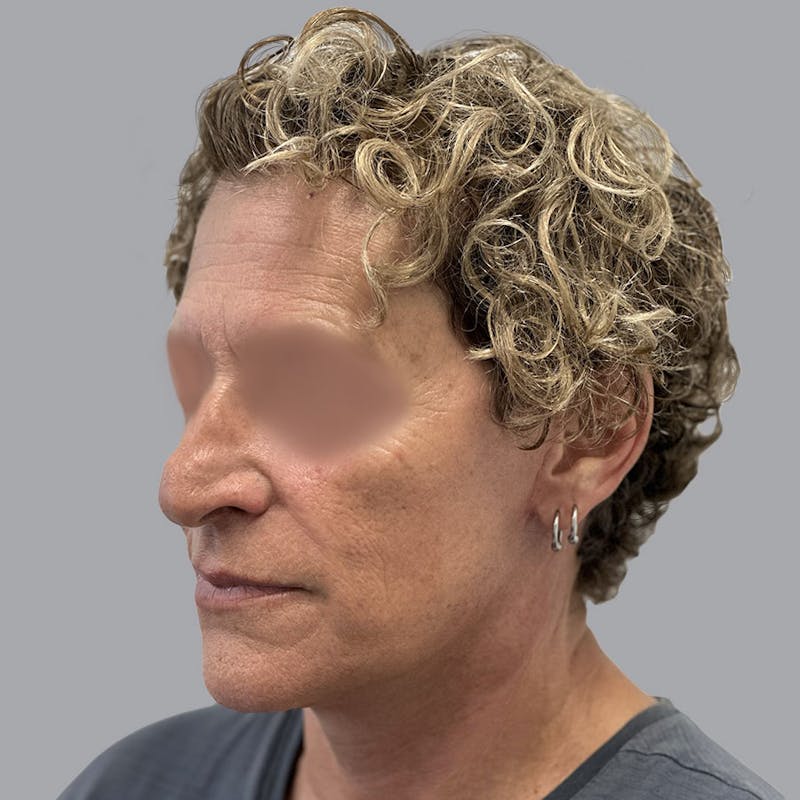 Facelift and Neck Lift Before & After Gallery - Patient 173374025 - Image 6