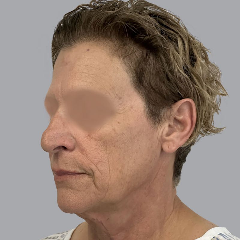 Facelift and Neck Lift Before & After Gallery - Patient 173374025 - Image 5