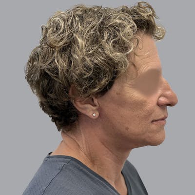 Facelift and Neck Lift Before & After Gallery - Patient 173374025 - Image 4