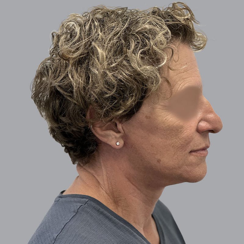 Facelift and Neck Lift Before & After Gallery - Patient 173374025 - Image 4