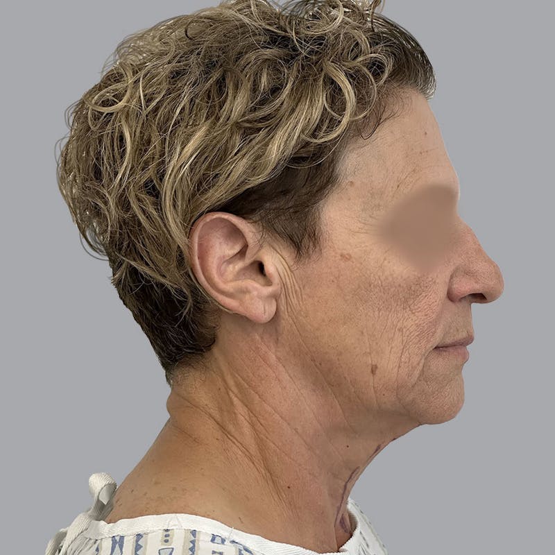 Facelift and Neck Lift Before & After Gallery - Patient 173374025 - Image 3