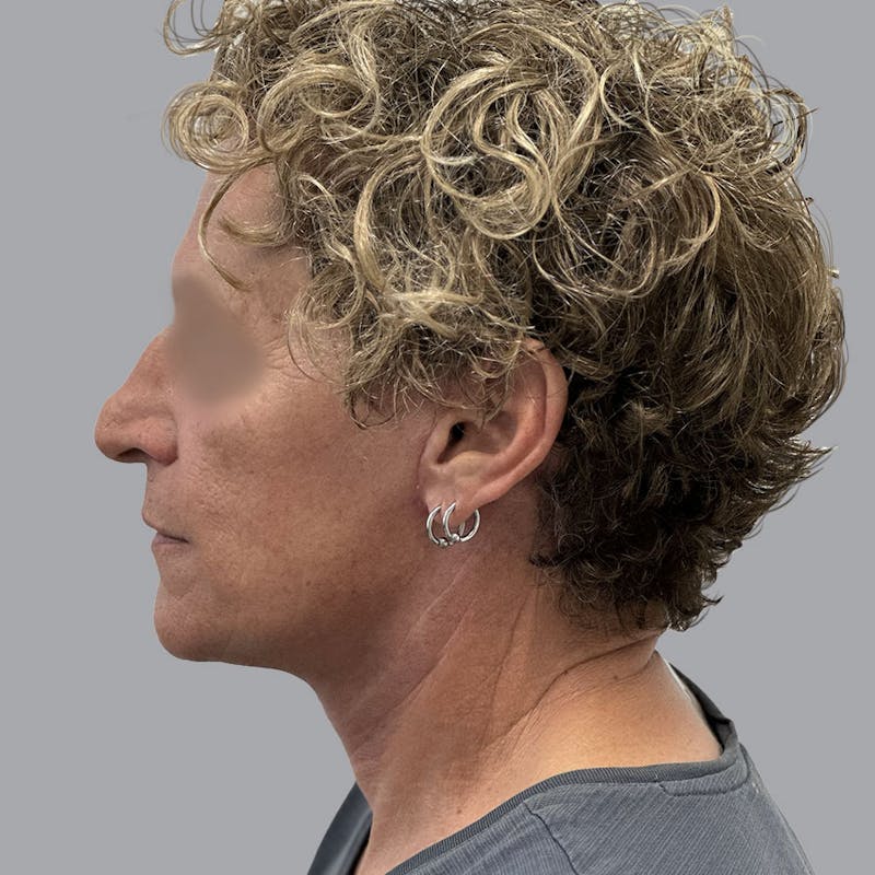 Facelift and Neck Lift Before & After Gallery - Patient 173374025 - Image 6