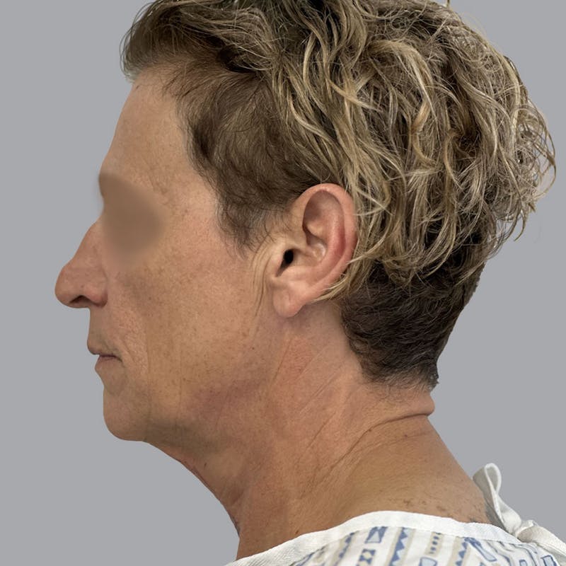 Facelift and Neck Lift Before & After Gallery - Patient 173374025 - Image 7
