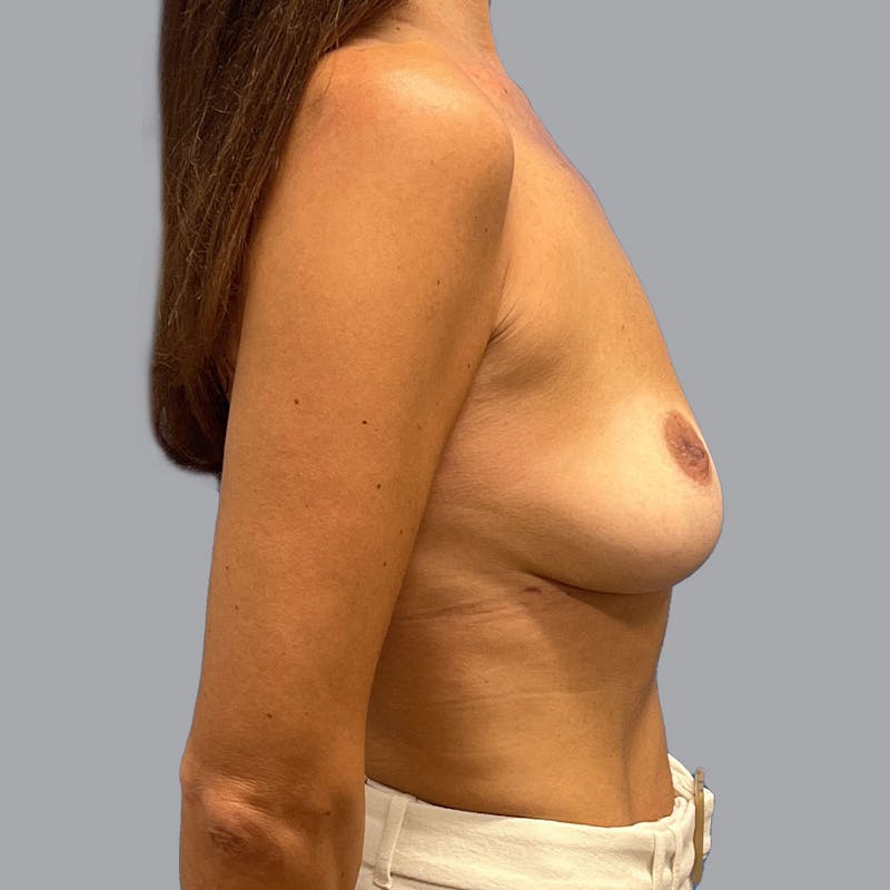 Breast Implant Removal Before & After Gallery - Patient 176492217 - Image 8