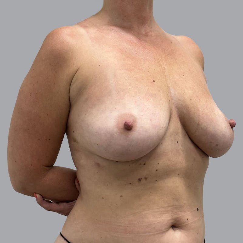 Breast Implant Removal Before & After Gallery - Patient 176745046 - Image 4