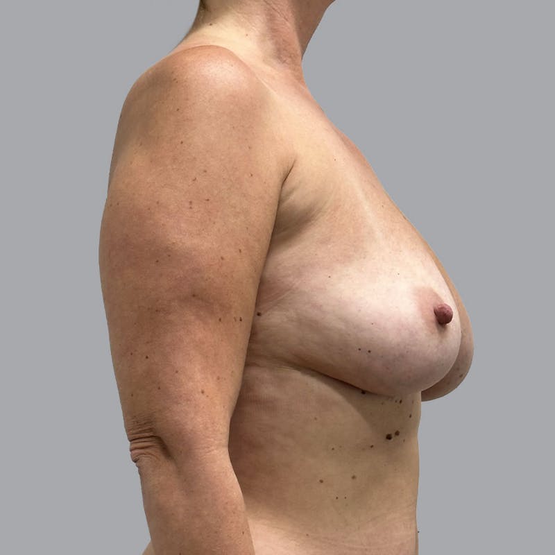 Breast Implant Removal Before & After Gallery - Patient 176745046 - Image 8