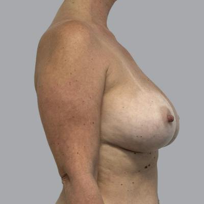 Breast Implant Removal Before & After Gallery - Patient 176745046 - Image 5