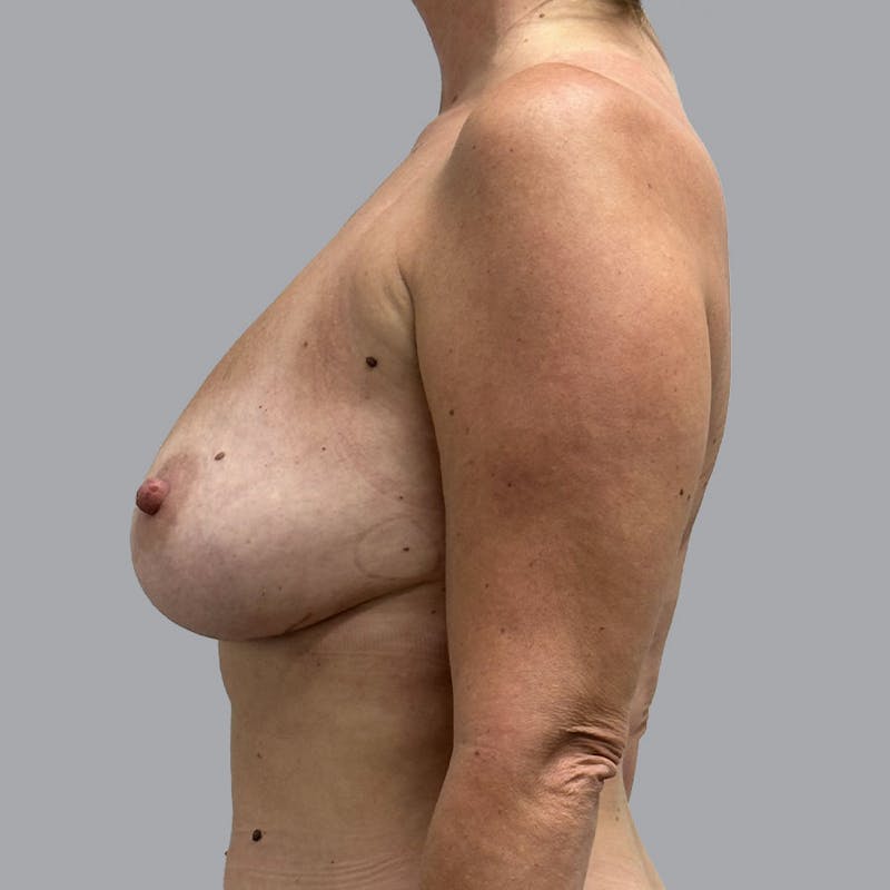 Breast Implant Removal Before & After Gallery - Patient 176745046 - Image 10